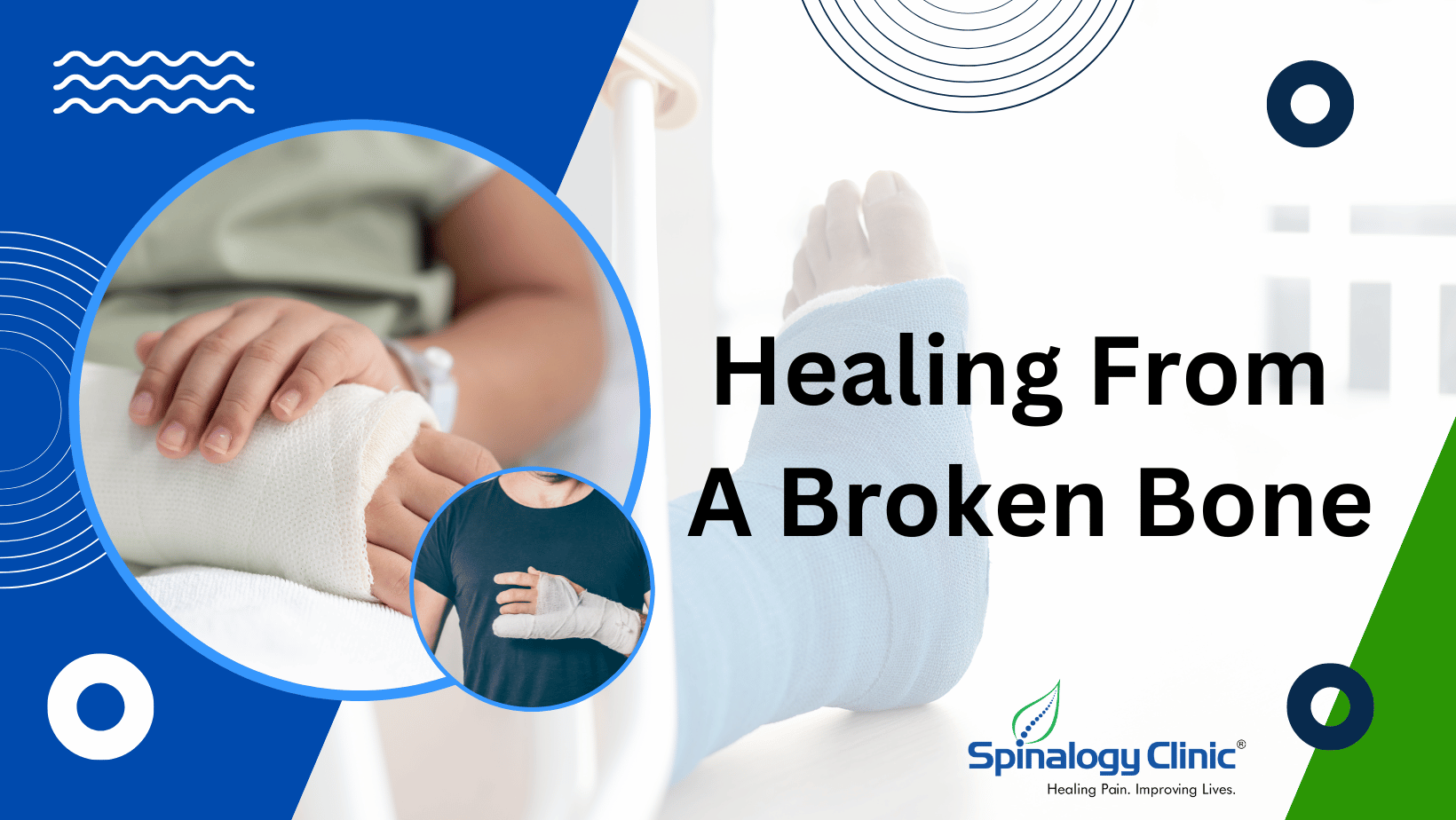 Healing From A Broken Bone